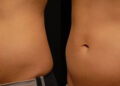 Does CoolSculpting Actually Work? What You Need to Know in OKC