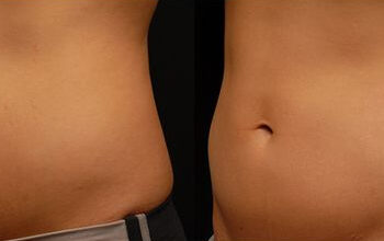 Does CoolSculpting Actually Work? What You Need to Know in OKC