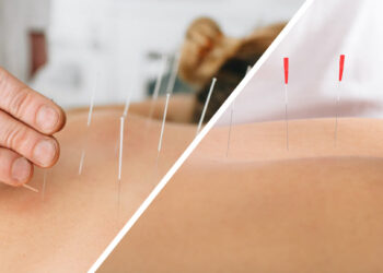 What Is Dry Needling and How Does It Work?