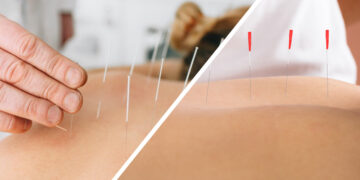 What Is Dry Needling and How Does It Work?