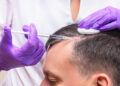 PRP Therapy for Hair Loss