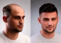 Premium Men’s Hair Pieces for Natural-Looking Results