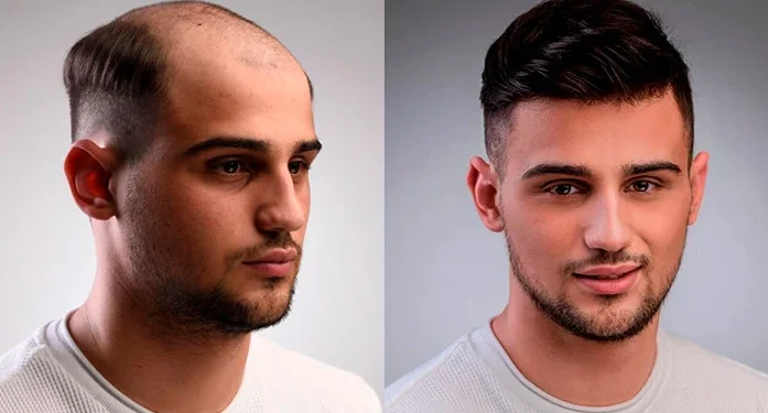 Premium Men’s Hair Pieces for Natural-Looking Results