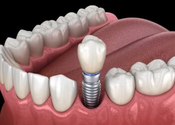 Your Loved One's Implant Doesn't Die With Them — Here's What Happens Next