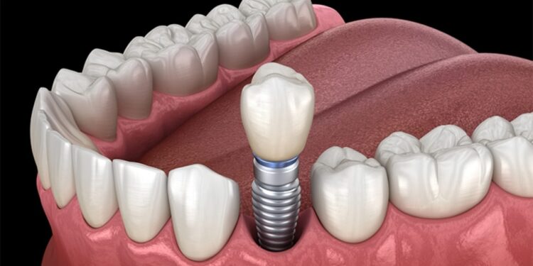 Your Loved One's Implant Doesn't Die With Them — Here's What Happens Next