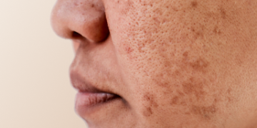 Revitalizing Your Complexion: Advanced Skin Resurfacing Techniques for South Florida Residents