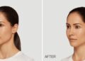 Cosmetic Treatments That Hide Fatigue From Back to Back Video Calls