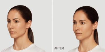 Cosmetic Treatments That Hide Fatigue From Back to Back Video Calls