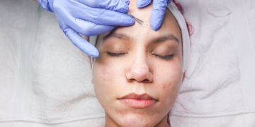 Understanding Acne Treatment Options in Dermatology Clinics
