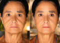 ProFractional Laser: What It Treats and What to Expect