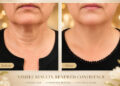 Halo Laser in Edina: What Twin Cities Patients Should Know