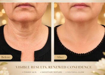 Halo Laser in Edina: What Twin Cities Patients Should Know