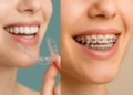 Invisalign vs Fixed Braces
