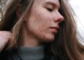 Beyond the Breakout: How to Fade Stubborn Post-Acne Marks