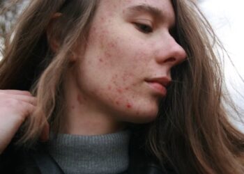 Beyond the Breakout: How to Fade Stubborn Post-Acne Marks