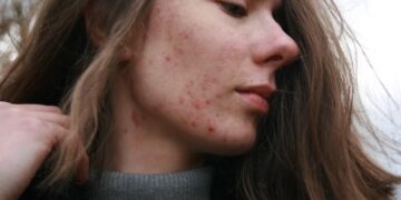 Beyond the Breakout: How to Fade Stubborn Post-Acne Marks