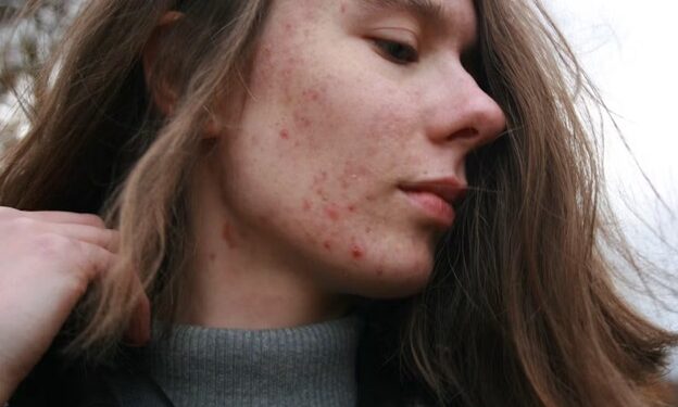 Beyond the Breakout: How to Fade Stubborn Post-Acne Marks